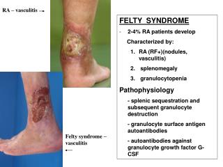 FELTY SYNDROME 2-4% RA patients develop Characterized by: RA (RF+)(nodules, vasculitis)