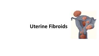 Uterine Fibroids