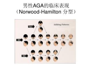男性 AGA 的临床表现 （ Norwood-Hamilton 分型）