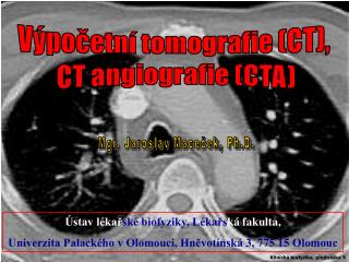 Výpočetní tomografie (CT), CT angiografie (CTA)
