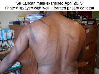 Sri Lankan male examined April 2013 Photo displayed with well-informed patient consent