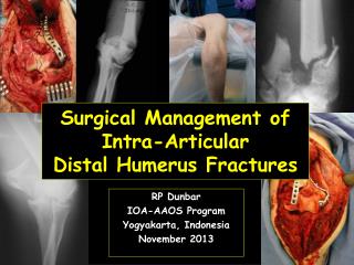 Surgical Management of Intra-Articular Distal Humerus Fractures