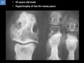 55 years old male Hypertrophy of toe for many years