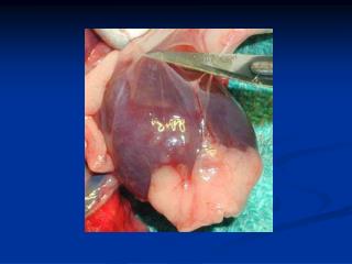 Acute Pericarditis and Pericardial Effusion