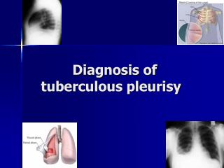Diagnosis of tuberculous pleurisy
