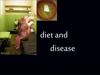 diet and 	disease