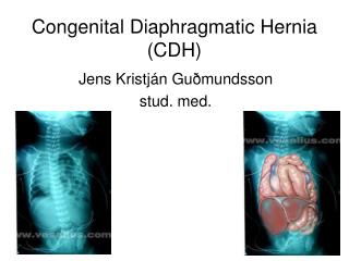 Congenital Diaphragmatic Hernia (CDH)