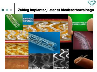Zabieg implantacji stentu bioabsorbowalnego