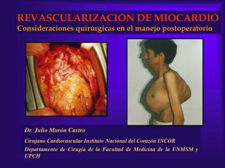 Dr. Julio Morón Castro Cirujano Cardiovascular Instituto Nacional del Corazón INCOR