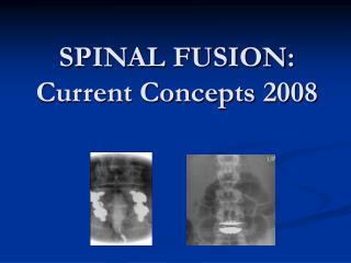 SPINAL FUSION: Current Concepts 2008