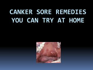 Easy Canker Sore Treatments at Home