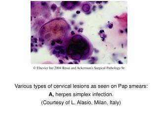 Various types of cervical lesions as seen on Pap smears: A, herpes simplex infection.