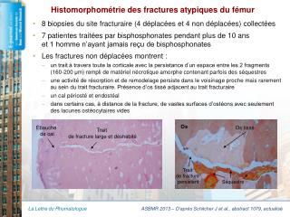 Histomorphométrie des fractures atypiques du fémur