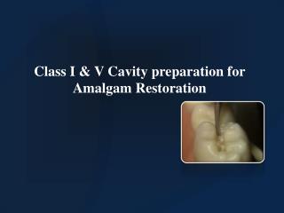 Class I &amp; V Cavity preparation for Amalgam Restoration