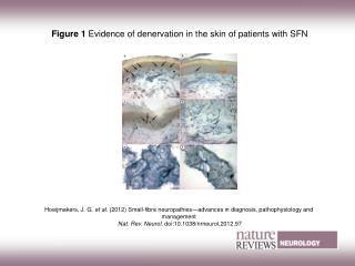 Figure 1 Evidence of denervation in the skin of patients with SFN
