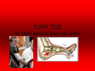 TURF TOE Its More serious they you think!