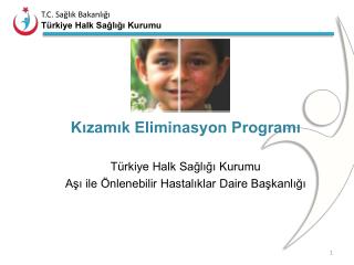 Kızamık Eliminasyon Programı Türkiye Halk Sağlığı Kurumu