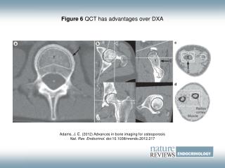 Figure 6 QCT has advantages over DXA