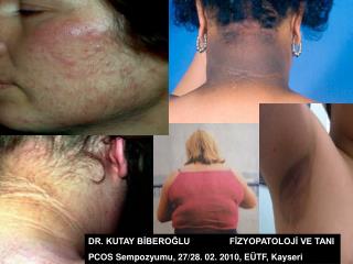 DR. KUTAY BİBEROĞLU		FİZYOPATOLOJİ VE TANI PCOS Sempozyumu, 27/28. 02. 2010, EÜTF, Kayseri