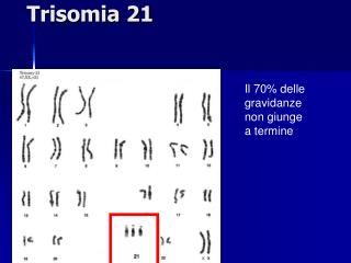 Trisomia 21