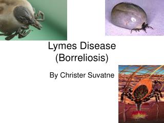 Lymes Disease (Borreliosis)