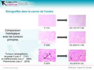 Xénogreffes dans le cancer de l’ovaire