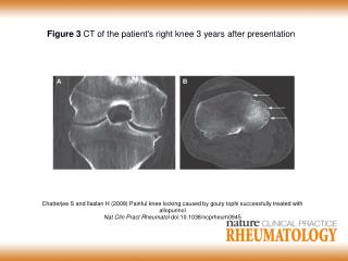 Figure 3 CT of the patient's right knee 3 years after presentation