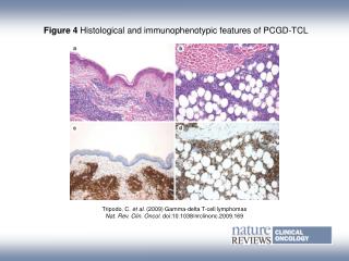 Figure 4 Histological and immunophenotypic features of PCGD‑TCL