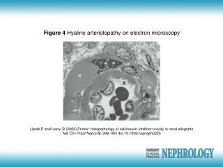 Figure 4 Hyaline arteriolopathy on electron microscopy