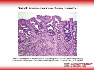Figure 3 Histologic appearance of chemical gastropathy