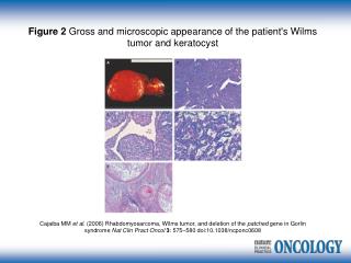 Figure 2 Gross and microscopic appearance of the patient's Wilms tumor and keratocyst