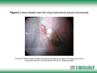 Figure 2 Lateral bladder wall with sling inadvertently placed intravesically
