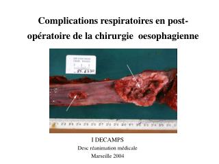 Complications respiratoires en post-opératoire de la chirurgie oesophagienne
