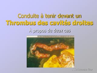 Conduite à tenir devant un Thrombus des cavités droites