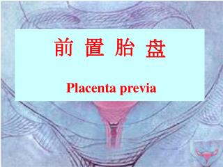 前 置 胎 盘 Placenta previa