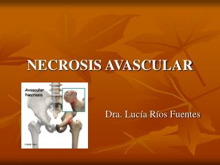 NECROSIS AVASCULAR