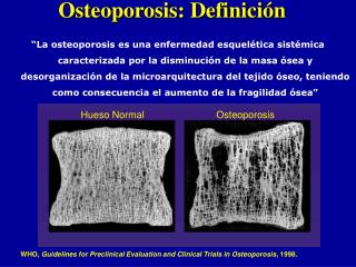 Osteoporosis: Defini c i ó n
