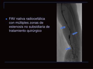 FAV nativa radiocefálica con múltiples zonas de estenosis no subsidiaria de tratamiento quirúrgico