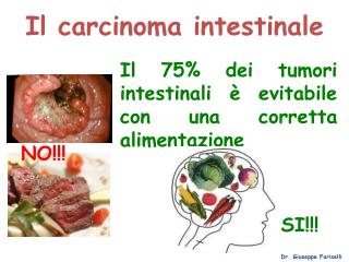 Il carcinoma intestinale