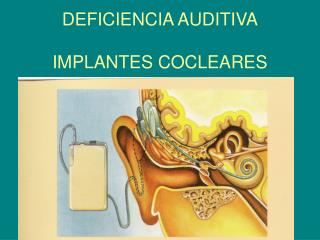 DEFICIENCIA AUDITIVA IMPLANTES COCLEARES