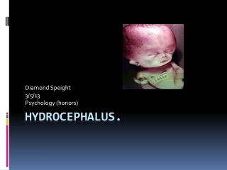 Hydrocephalus.