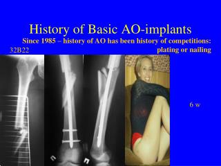 History of Basic AO-implants