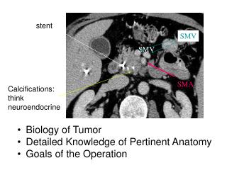 Calcifications: think neuroendocrine