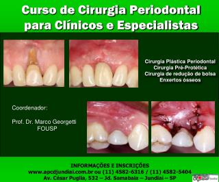 Curso de Cirurgia Periodontal para Clínicos e Especialistas