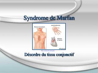 Syndrome de Marfan
