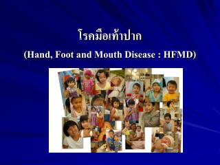 โรคมือเท้าปาก (Hand, Foot and Mouth Disease : HFMD)
