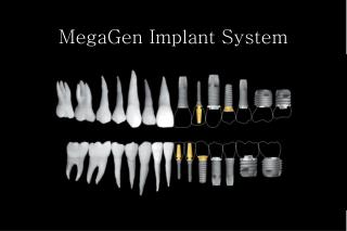 MegaGen Implant System