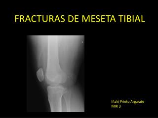 FRACTURAS DE MESETA TIBIAL