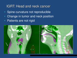 IGRT: Head and neck cancer