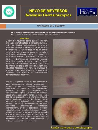NEVO DE MEYERSON Avaliação Dermatoscópica